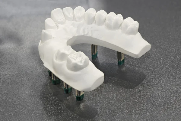 Plaster model of teeth — Stock Photo, Image