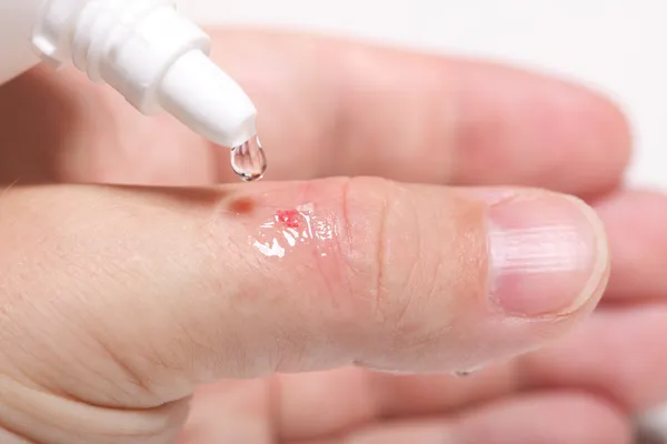 Disinfettare il graffio alcol taglia la salute della mano — Foto Stock