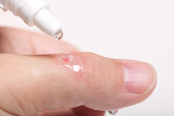 Disinfettare il graffio alcol taglia la salute della mano — Foto Stock