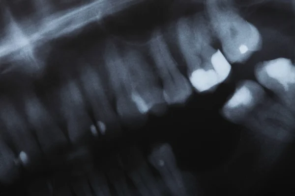 Scansione a raggi X dei denti umani — Foto Stock