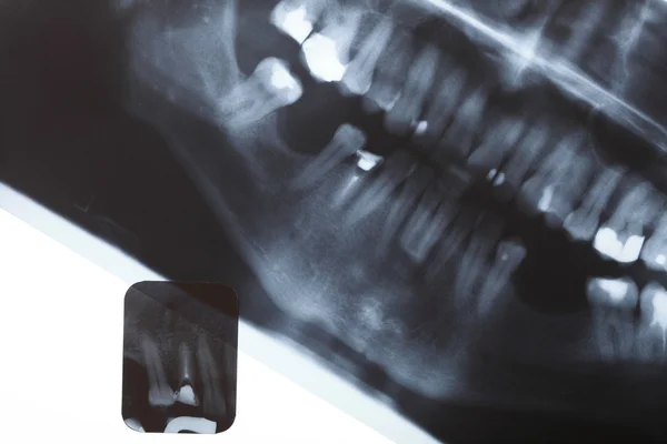 Röntgenbild menschlicher Zähne — Stockfoto