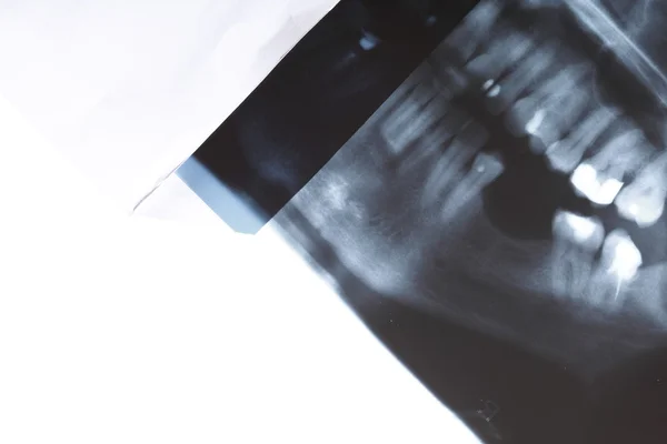 Рентгеновское сканирование человеческих зубов — стоковое фото