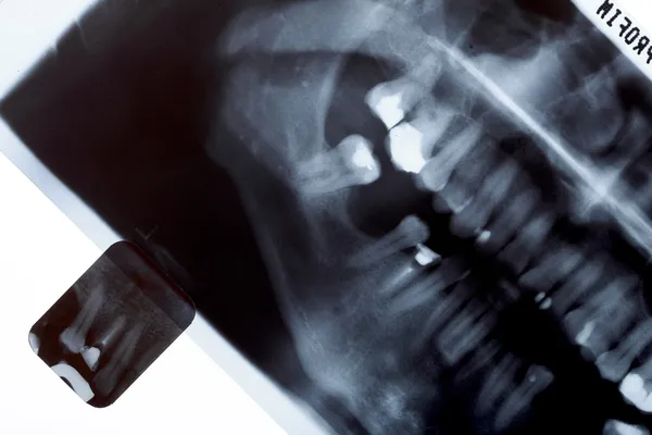 Scanarea cu raze X a dinților umani — Fotografie, imagine de stoc