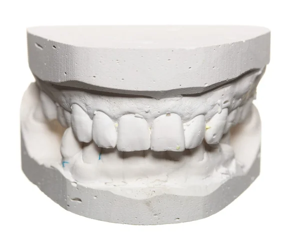 Dental gypsum model mould of teeth in plaster — Stock Photo, Image