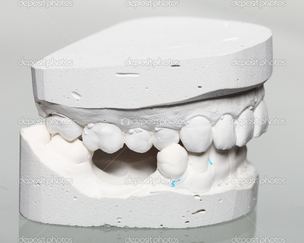 Dental gypsum model mould of teeth in plaster — Stock Photo © Voyagerix