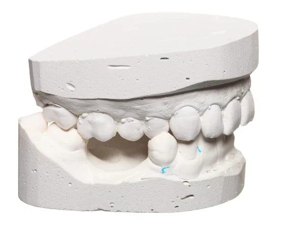 Dental gypsum model mould of teeth in plaster — Stock Photo, Image