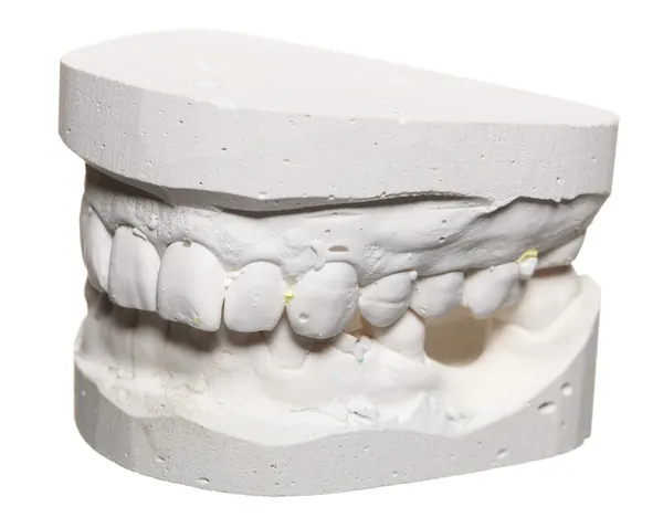 Dental gypsum model mould of teeth in plaster — Stock Photo, Image