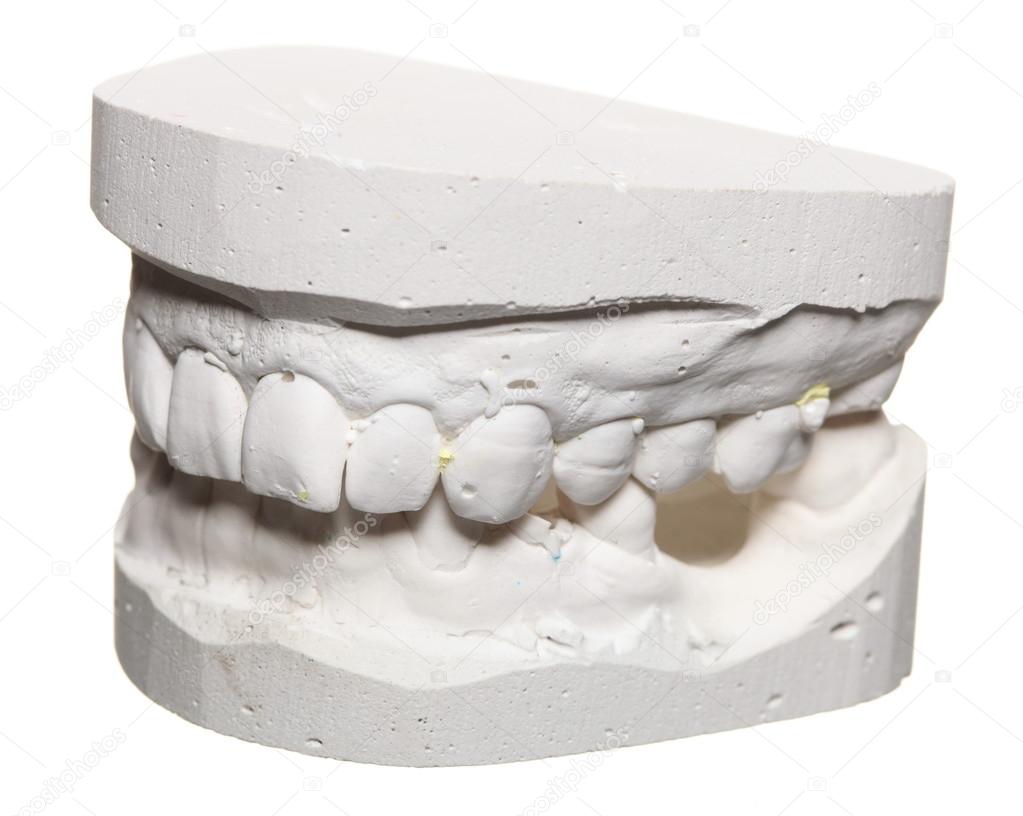 Dental gypsum model mould of teeth in plaster ⬇ Stock Photo, Image by