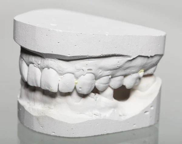 Dental gypsum model mould of teeth in plaster — Stock Photo, Image