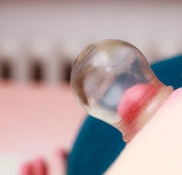 Medicina alternativa. Fuego ventosa masaje detalle en la espalda de la mujer — Foto de Stock