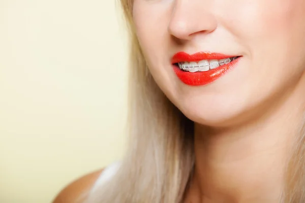 Smiling girl with braces face part teeth straighten, tooth hygiene — Stock Photo, Image