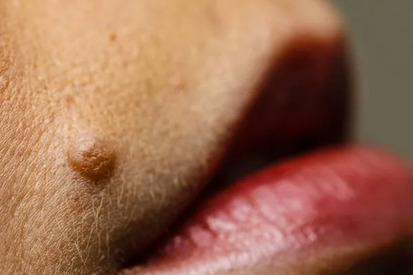 Δερματική Ασθένεια Κοντινό Σημάδι Στο Γυναικείο Πρόσωπο Κοντά Στα Χείλη — Φωτογραφία Αρχείου
