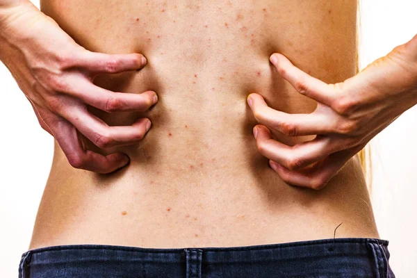 Health Problem Skin Diseases Young Woman Showing Her Back Acne — Stock Photo, Image