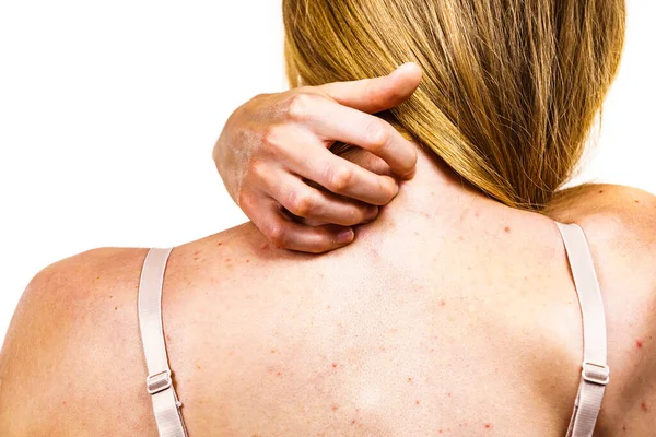 健康问题 皮肤病 年轻的女人背带着粉刺和红斑少女用粉刺挠着肩膀 — 图库照片