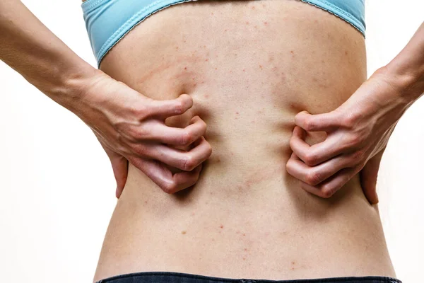 Picazón Piel Dermatitis Alergias Alimentarias Mujer Mostrando Espalda Con Acné —  Fotos de Stock