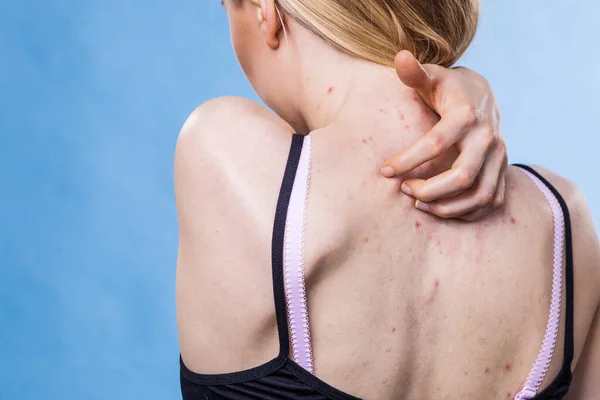 Problema Salud Enfermedades Piel Mujer Joven Mostrando Espalda Con Acné —  Fotos de Stock