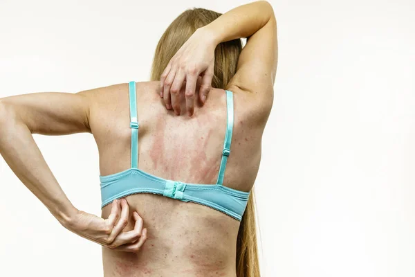 Молодая Женщина Страдает Зуда Коже Чесания Спины Аллергическая Реакция Еду — стоковое фото