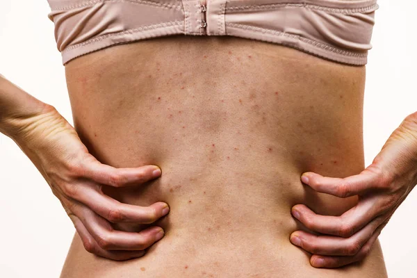 Health Problem Skin Diseases Young Woman Showing Her Back Acne — Stock Photo, Image