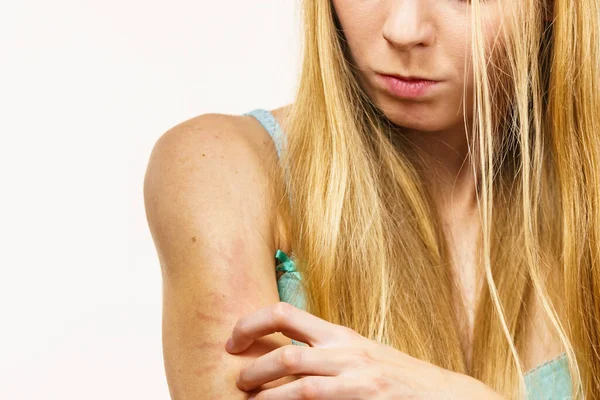 Pele Com Comichão Dermatite Alergias Alimentares Mulher Com Coceira Coçando — Fotografia de Stock