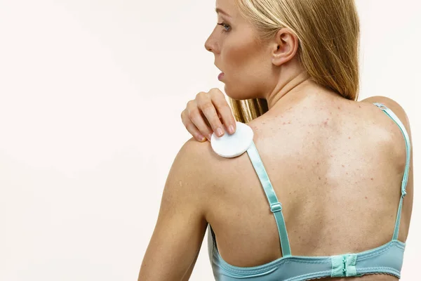 피부병 여드름 면직물 패드를 사용하여 피부를 청소하는 — 스톡 사진