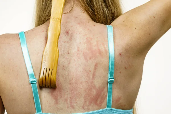 Pele Com Comichão Dermatite Alergias Alimentares Mulher Usando Pau Madeira — Fotografia de Stock