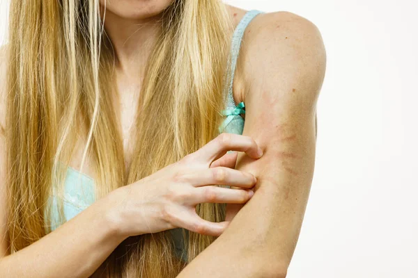 Itchy Skin Dermatitis Food Allergies Woman Having Itching Scratching Her — Stock Photo, Image