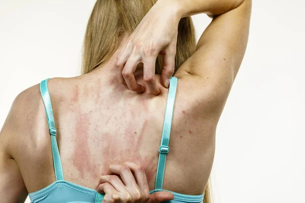 Young Woman Suffering Itching Her Skin Scratching Itchy Back Allergic — Stock Photo, Image