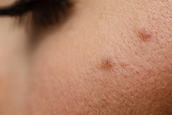 Kožní Nemoc Detailní Krtek Tváři Ženy — Stock fotografie