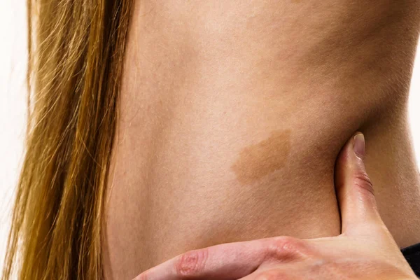 Primer Plano Marca Nacimiento Marrón Piel Del Cuerpo Femenino — Foto de Stock