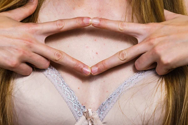 Problema Saúde Doenças Pele Jovem Mostrando Seu Decote Com Acne — Fotografia de Stock