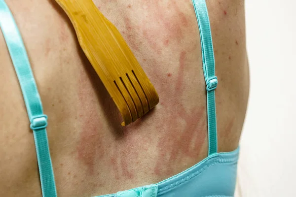 Picazón Piel Dermatitis Alergias Alimentarias Mujer Que Usa Palillo Madera — Foto de Stock
