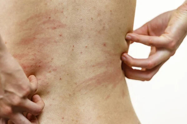 Itchy skin, dermatitis, food allergies. Woman showing her back with acne, red spots. Female having itching, scratching her body with allergy rash.