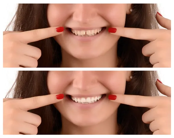 Vor gelben Zähnen mit Lücke und nach weißen Zähnen ohne Lücke. — Stockfoto