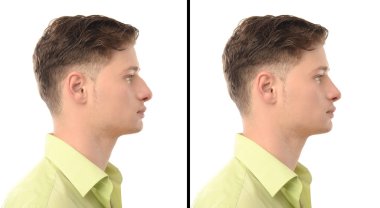 Man with rhinoplasty. Before and after photos of a young man with nose job plastic surgery. clipart