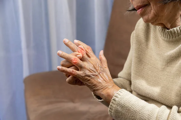 Senior Vrouw Massage Vinger Met Pijnlijke Gezwollen Jicht — Stockfoto