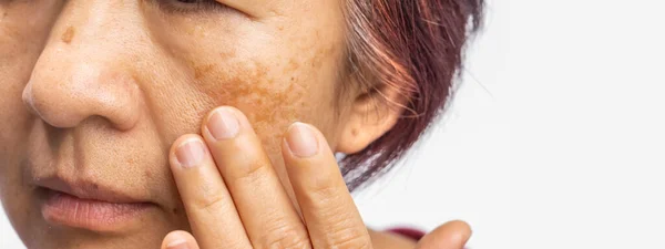 Menopausala Kvinnor Oroar Sig För Melasma Ansiktet — Stockfoto