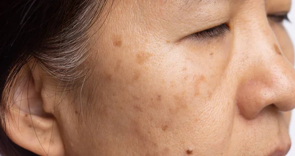 Donne Menopausa Preoccupano Del Melasma Sul Viso — Foto Stock