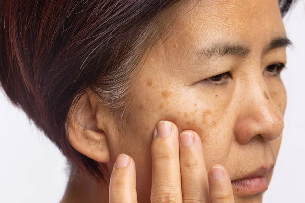 Menopausala Kvinnor Oroar Sig För Melasma Ansiktet — Stockfoto