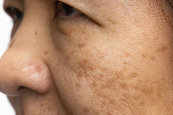更年期女性担心脸上的黑色素瘤 — 图库照片