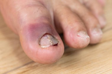 Sol ayak tırnağında çürük var.