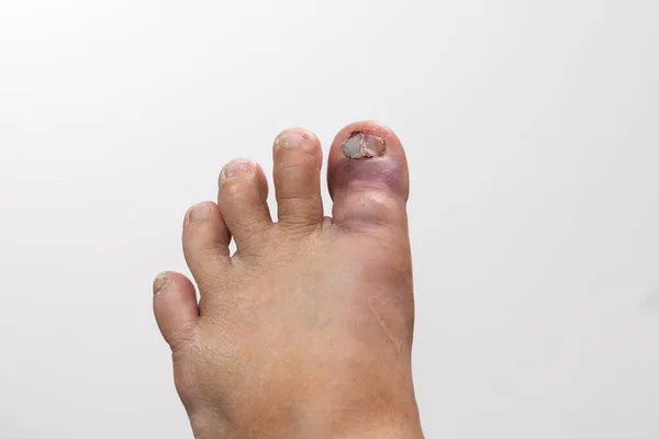 Bruise Toenail Left Foot — 스톡 사진