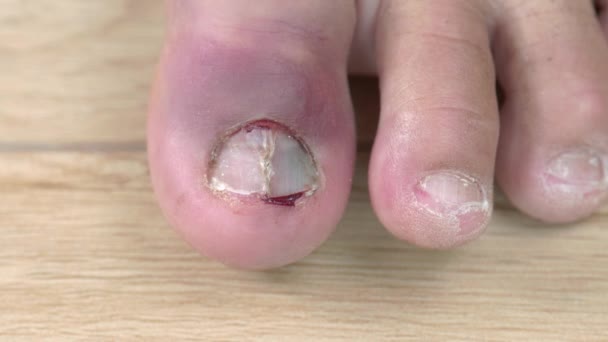Bruise Toenail Left Foot — стоковое видео