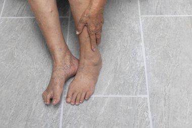 Yaşlı kadın ayağına acı veren bir gut iltihabıyla masaj yapıyor.