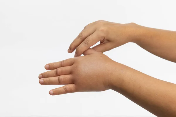 虫刺されのアレルギーから手を腫らします 皮膚アレルギーケア — ストック写真