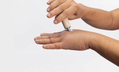 Kadın böcek sokmasına alerjisi olduğu için şişmiş eline krem sürmüş. Cilt alerjisi.