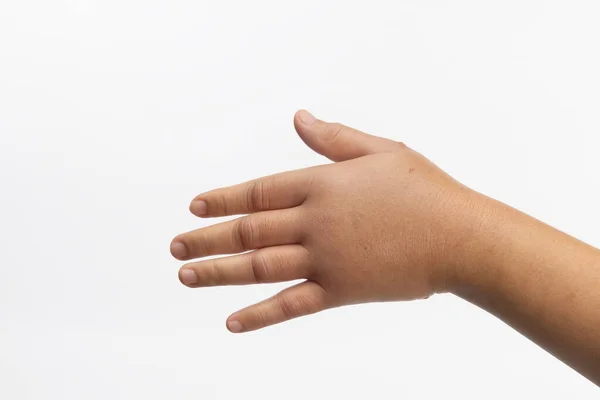 虫刺されのアレルギーから手を腫らします 皮膚アレルギーケア — ストック写真