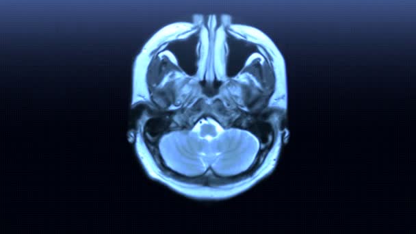 Mri Scan — Stockvideo