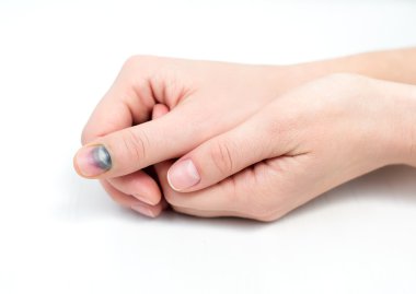 Bruise on nail clipart