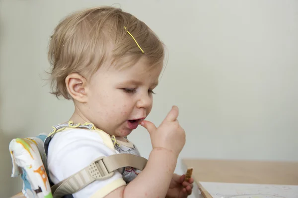 Toddler with hand , foot and mouth disease — Stock Photo, Image