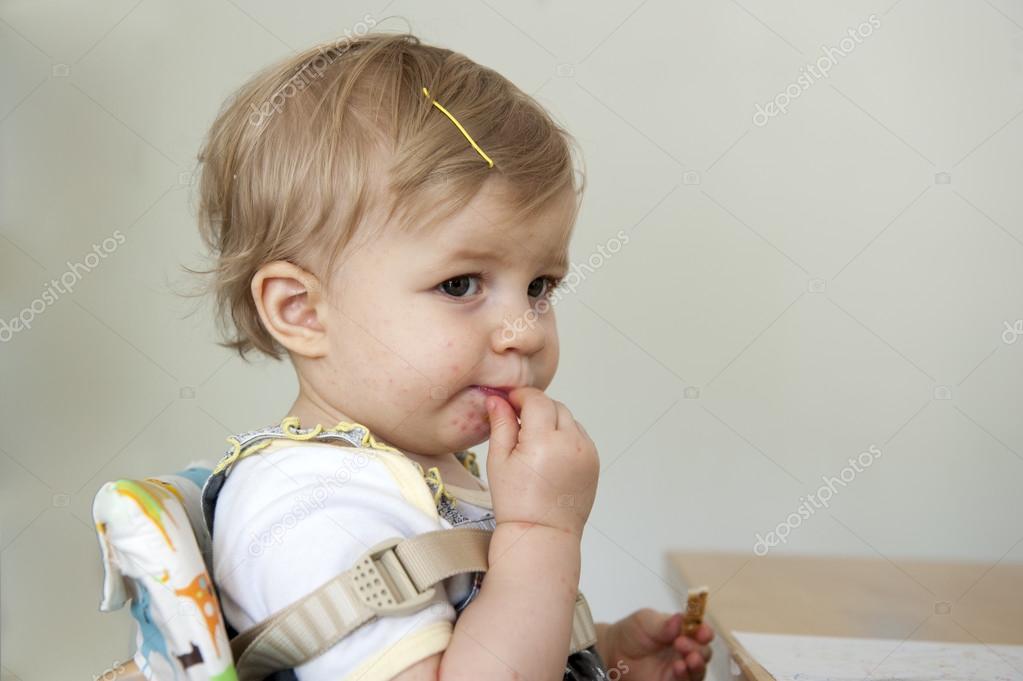 Toddler With Hand Foot And Mouth Disease Stock Photo Aldegonde toddler-with-hand-foot-and-mouth-disease-stock-photo-aldegonde